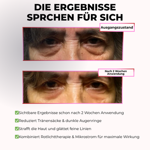 GlowEyes Pro™ - 2-in-1 Rotlichttherapie + EMS zur Beseitigung von Augenringen